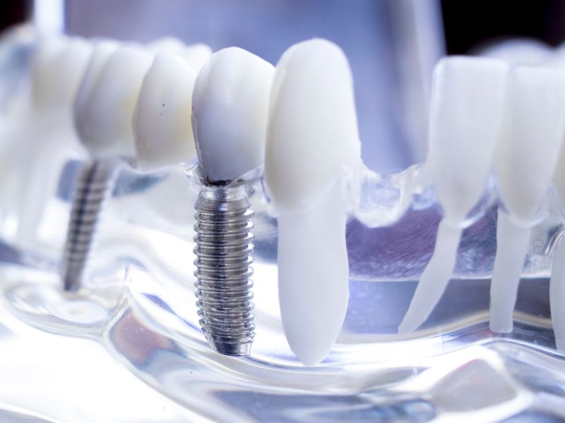 Implantes Dentales en Zaragoza: La Solución de Calidad que Ofrece la Clínica Dehental